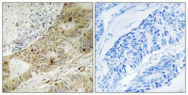Immunohistochemistry analysis of paraffin-embedded human colon carcinoma tissue, using ATRIP (Phospho-Ser224) antibody. The picture on the right is treated with the synthesized peptide.