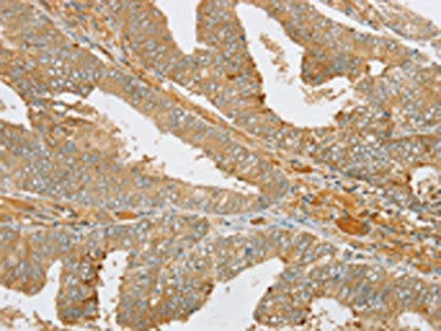 The image on the left is immunohistochemistry of paraffin-embedded Human cervical cancer tissue using PDP1 Antibody(PDP1 Antibody) at dilution 1/25, on the right is treated with fusion protein. (Original magnification: ×200)Rabbit anti-Human PDP1 Polyclonal Antibody