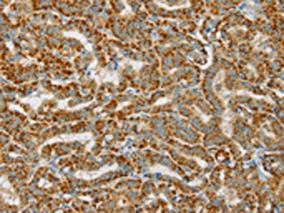 The image on the left is immunohistochemistry of paraffin-embedded Human thyroid cancer tissue using the antibody Antibody) at dilution 1/25, on the right is treated with fusion protein. (Original magnification: ×200)Rabbit anti-Human PDP1 Polyclonal Antibody