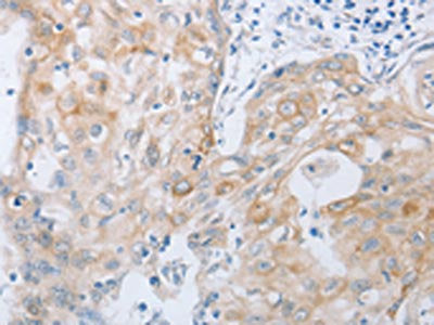 The image on the left is immunohistochemistry of paraffin-embedded Human cervical cancer tissue using TACR2 Antibody(TACR2 Antibody) at dilution 1/10, on the right is treated with synthetic peptide. (Original magnification: ×200)Rabbit anti-Human TACR2 Polyclonal Antibody