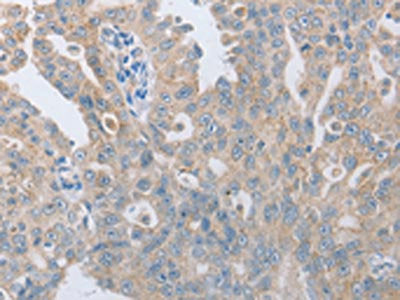 The image on the left is immunohistochemistry of paraffin-embedded Human ovarian cancer tissue using the antibody Antibody) at dilution 1/10, on the right is treated with synthetic peptide. (Original magnification: ×200)Rabbit anti-Human TACR2 Polyclonal Antibody