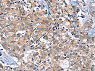 The image on the left is immunohistochemistry of paraffin-embedded Human breast cancer tissue using the antibody Antibody) at dilution 1/40, on the right is treated with fusion protein. (Original magnification: ×200)Rabbit anti-Human OTUB1 Polyclonal Antibody