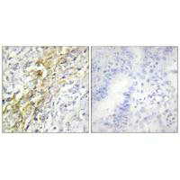 Immunohistochemistry analysis of paraffin-embedded human lung carcinoma tissue using CKI-α antibody.Rabbit anti-Human CSNK1A1 Polyclonal Antibody