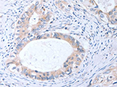 The image on the left is immunohistochemistry of paraffin-embedded Human cervical cancer tissue using TIMP3 Antibody(TIMP3 Antibody) at dilution 1/20, on the right is treated with fusion protein. (Original magnification: ×200)Rabbit anti-Human TIMP3 Polyclonal Antibody