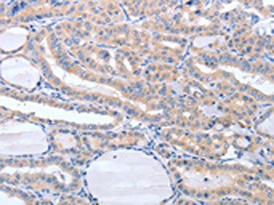 The image on the left is immunohistochemistry of paraffin-embedded Human thyroid cancer tissue using the antibody Antibody) at dilution 1/20, on the right is treated with fusion protein. (Original magnification: ×200)Rabbit anti-Human TIMP3 Polyclonal Antibody