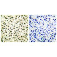 Immunohistochemical analysis of paraffin-embedded human breast carcinoma tissue using Ku70/80 antibody.Rabbit anti-Human XRCC6/XRCC5 Polyclonal Antibody