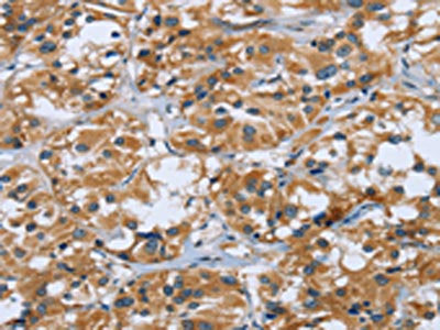 The image on the left is immunohistochemistry of paraffin-embedded Human thyroid cancer tissue using the antibody Antibody) at dilution 1/40, on the right is treated with fusion protein. (Original magnification: ×200)Rabbit anti-Human RAP1B Polyclonal Antibody