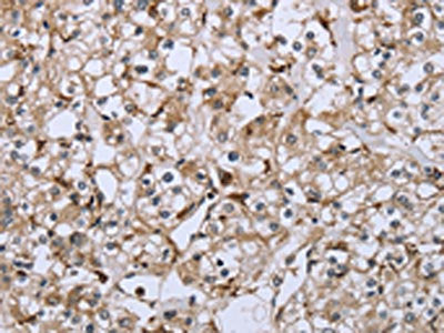 The image on the left is immunohistochemistry of paraffin-embedded Human prostate cancer tissue using FCGR2B Antibody(FCGR2B Antibody) at dilution 1/40, on the right is treated with fusion protein. (Original magnification: ×200)Rabbit anti-Human FCGR2B Polyclonal Antibody