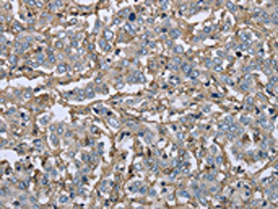 The image on the left is immunohistochemistry of paraffin-embedded Human liver cancer tissue using the antibody Antibody) at dilution 1/40, on the right is treated with fusion protein. (Original magnification: ×200)Rabbit anti-Human FCGR2B Polyclonal Antibody