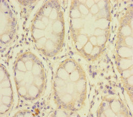 Immunohistochemistry of paraffin-embedded human colon cancer using SLC39A7 Antibody at dilution of 1:100Rabbit anti-Human SLC39A7 Polyclonal Antibody