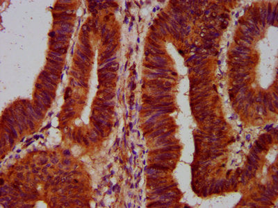 IHC image of SLC5A5 Antibody diluted at 1:500 and staining in paraffin-embedded human colon cancer performed on a Leica BondTM system. After dewaxing and hydration, antigen retrieval was mediated by high pressure in a citrate buffer (pH 6.0). Section was blocked with 10% normal goat serum 30min at RT. Then primary antibody (1% BSA) was incubated at 4°C overnight. The primary is detected by a biotinylated secondary antibody and visualized using an HRP conjugated SP system.Rabbit anti-Human SLC5A5 Polyclonal Antibody