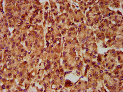IHC image of SLC5A5 Antibody diluted at 1:500 and staining in paraffin-embedded human pancreatic cancer performed on a Leica BondTM system. After dewaxing and hydration, antigen retrieval was mediated by high pressure in a citrate buffer (pH 6.0). Section was blocked with 10% normal goat serum 30min at RT. Then primary antibody (1% BSA) was incubated at 4°C overnight. The primary is detected by a biotinylated secondary antibody and visualized using an HRP conjugated SP system.Rabbit anti-Human SLC5A5 Polyclonal Antibody