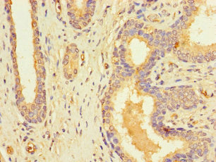 Immunohistochemistry of paraffin-embedded human prostate cancer using the antibody at dilution of 1:100Rabbit anti-Human RFK Polyclonal Antibody