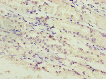 Immunohistochemistry of paraffin-embedded human gastric cancer using PPP2R3C Antibody at dilution of 1:100Rabbit anti-Human PPP2R3C Polyclonal Antibody