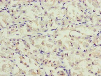 Immunohistochemistry of paraffin-embedded human gastric cancer using PPP2R3C Antibody at dilution of 1:100Rabbit anti-Human PPP2R3C Polyclonal Antibody