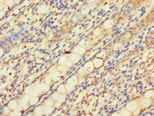 Immunohistochemistry of paraffin-embedded human colon tissue using PNPLA2 Antibody at dilution of 1:100Rabbit anti-Human PNPLA2 Polyclonal Antibody