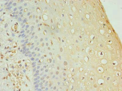 Immunohistochemistry of paraffin-embedded human cervical cancer using FAM136A Antibody at dilution of 1:100Rabbit anti-Human FAM136A Polyclonal Antibody