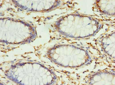 Immunohistochemistry of paraffin-embedded human colon cancer using RPUSD4 Antibody at dilution of 1:100Rabbit anti-Human RPUSD4 Polyclonal Antibody