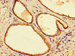 Immunohistochemistry of paraffin-embedded human prostate cancer using YIPF6 Antibody at dilution of 1:100Rabbit anti-Human YIPF6 Polyclonal Antibody