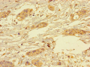 Immunohistochemistry of paraffin-embedded human pancreatic cancer using YIPF6 Antibody at dilution of 1:100Rabbit anti-Human YIPF6 Polyclonal Antibody