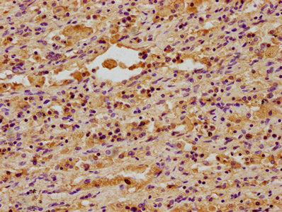 IHC image of DNAJA3 Antibody diluted at 1:400 and staining in paraffin-embedded human lung cancer performed on a Leica BondTM system. After dewaxing and hydration, antigen retrieval was mediated by high pressure in a citrate buffer (pH 6.0). Section was blocked with 10% normal goat serum 30min at RT. Then primary antibody (1% BSA) was incubated at 4°C overnight. The primary is detected by a biotinylated secondary antibody and visualized using an HRP conjugated SP system.Rabbit anti-Human DNAJA3 Polyclonal Antibody