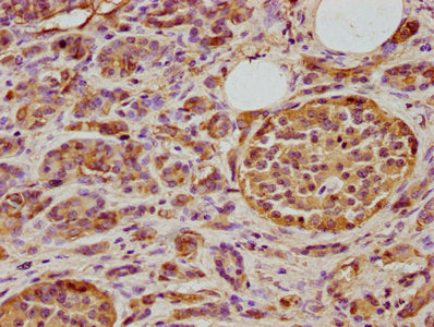 IHC image of DNAJA3 Antibody diluted at 1:400 and staining in paraffin-embedded human pancreatic cancer performed on a Leica BondTM system. After dewaxing and hydration, antigen retrieval was mediated by high pressure in a citrate buffer (pH 6.0). Section was blocked with 10% normal goat serum 30min at RT. Then primary antibody (1% BSA) was incubated at 4°C overnight. The primary is detected by a biotinylated secondary antibody and visualized using an HRP conjugated SP system.Rabbit anti-Human DNAJA3 Polyclonal Antibody