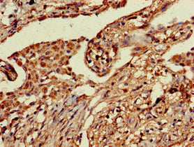 Immunohistochemistry of paraffin-embedded human lung cancer using the antibody at dilution of 1:100Rabbit anti-Human PRR11 Polyclonal Antibody