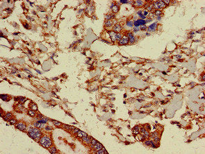 Immunohistochemistry of paraffin-embedded human pancreatic cancer using PRR11 Antibody at dilution of 1:100Rabbit anti-Human PRR11 Polyclonal Antibody