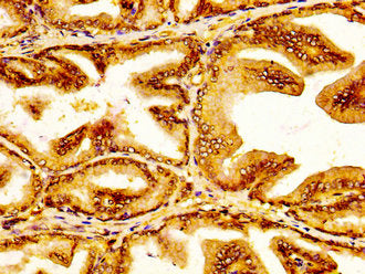 IHC image of the antibody diluted at 1:300 and staining in paraffin-embedded human prostate tissue performed on a Leica BondTM system. After dewaxing and hydration, antigen retrieval was mediated by high pressure in a citrate buffer (pH 6.0). Section was blocked with 10% normal goat serum 30min at RT. Then primary antibody (1% BSA) was incubated at 4°C overnight. The primary is detected by a biotinylated secondary antibody and visualized using an HRP conjugated SP system.Rabbit anti-Human SLC45A3 Polyclonal Antibody