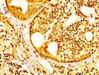 IHC image of SLC45A3 Antibody diluted at 1:300 and staining in paraffin-embedded human prostate cancer performed on a Leica BondTM system. After dewaxing and hydration, antigen retrieval was mediated by high pressure in a citrate buffer (pH 6.0). Section was blocked with 10% normal goat serum 30min at RT. Then primary antibody (1% BSA) was incubated at 4°C overnight. The primary is detected by a biotinylated secondary antibody and visualized using an HRP conjugated SP system.Rabbit anti-Human SLC45A3 Polyclonal Antibody
