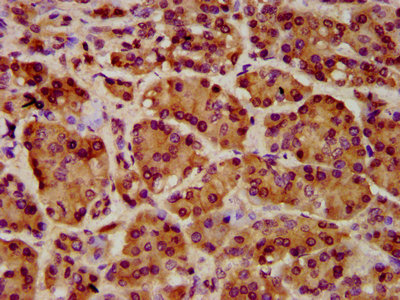 IHC image of the antibody diluted at 1:1000 and staining in paraffin-embedded human pancreatic cancer performed on a Leica BondTM system. After dewaxing and hydration, antigen retrieval was mediated by high pressure in a citrate buffer (pH 6.0). Section was blocked with 10% normal goat serum 30min at RT. Then primary antibody (1% BSA) was incubated at 4°C overnight. The primary is detected by a biotinylated secondary antibody and visualized using an HRP conjugated SP system.Rabbit anti-Human ART5 Polyclonal Antibody