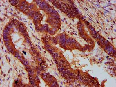 IHC image of the antibody diluted at 1:300 and staining in paraffin-embedded human colon cancer performed on a Leica BondTM system. After dewaxing and hydration, antigen retrieval was mediated by high pressure in a citrate buffer (pH 6.0). Section was blocked with 10% normal goat serum 30min at RT. Then primary antibody (1% BSA) was incubated at 4°C overnight. The primary is detected by a biotinylated secondary antibody and visualized using an HRP conjugated SP system.Rabbit anti-Human MOGAT1 Polyclonal Antibody