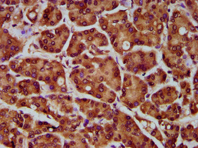 IHC image of MOGAT1 Antibody diluted at 1:300 and staining in paraffin-embedded human pancreatic cancer performed on a Leica BondTM system. After dewaxing and hydration, antigen retrieval was mediated by high pressure in a citrate buffer (pH 6.0). Section was blocked with 10% normal goat serum 30min at RT. Then primary antibody (1% BSA) was incubated at 4°C overnight. The primary is detected by a biotinylated secondary antibody and visualized using an HRP conjugated SP system.Rabbit anti-Human MOGAT1 Polyclonal Antibody