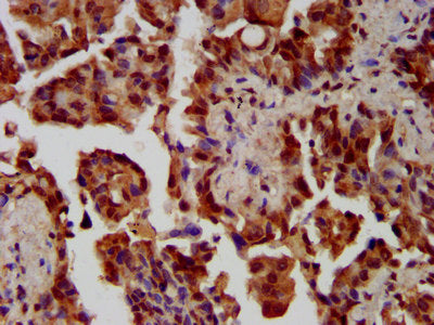 IHC image of NEK1 Antibody diluted at 1:300 and staining in paraffin-embedded human lung cancer performed on a Leica BondTM system. After dewaxing and hydration, antigen retrieval was mediated by high pressure in a citrate buffer (pH 6.0). Section was blocked with 10% normal goat serum 30min at RT. Then primary antibody (1% BSA) was incubated at 4°C overnight. The primary is detected by a biotinylated secondary antibody and visualized using an HRP conjugated SP system.Rabbit anti-Human NEK1 Polyclonal Antibody