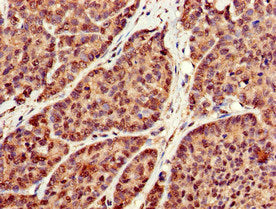 Immunohistochemistry of paraffin-embedded human ovarian cancer using RBFA Antibody at dilution of 1:100Rabbit anti-Human RBFA Polyclonal Antibody