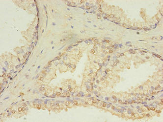 Immunohistochemistry of paraffin-embedded human prostate cancer using HDDC3 Antibody at dilution of 1:100Rabbit anti-Human HDDC3 Polyclonal Antibody