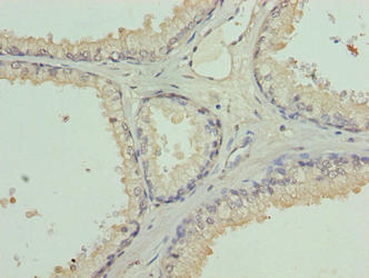 Immunohistochemistry of paraffin-embedded human prostate cancer using L3MBTL4 Antibody at dilution of 1:100