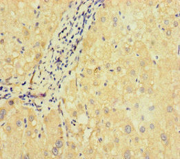 Immunohistochemistry of paraffin-embedded human liver cancer using SLC38A9 Antibody at dilution of 1:100Rabbit anti-Human SLC38A9 Polyclonal Antibody