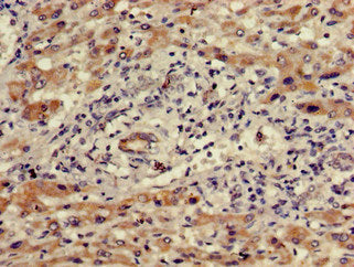 Immunohistochemistry of paraffin-embedded human liver cancer using WDR19 Antibody at dilution of 1:100Rabbit anti-Human WDR19 Polyclonal Antibody