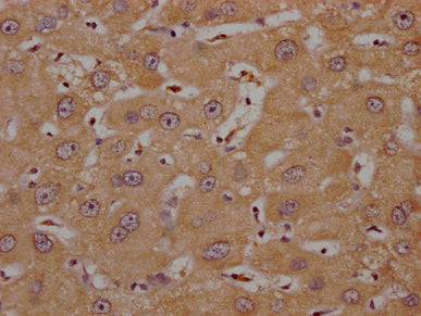 IHC image of the antibody diluted at 1:200 and staining in paraffin-embedded human liver cancer performed on a Leica BondTM system. After dewaxing and hydration, antigen retrieval was mediated by high pressure in a citrate buffer (pH 6.0). Section was blocked with 10% normal goat serum 30min at RT. Then primary antibody (1% BSA) was incubated at 4°C overnight. The primary is detected by a Goat anti-rabbit polymer IgG labeled by HRP and visualized using 0.05% DAB.Rabbit anti-Human OR4C15 Polyclonal Antibody