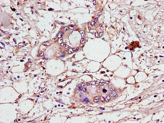 Immunohistochemistry of paraffin-embedded human pancreatic cancer using CEP70 Antibody at dilution of 1:100Rabbit anti-Human CEP70 Polyclonal Antibody