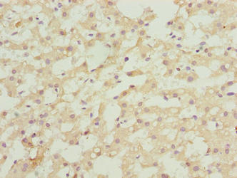 Immunohistochemistry of paraffin-embedded human liver cancer using ASAP3 Antibody at dilution of 1:100Rabbit anti-Human ASAP3 Polyclonal Antibody