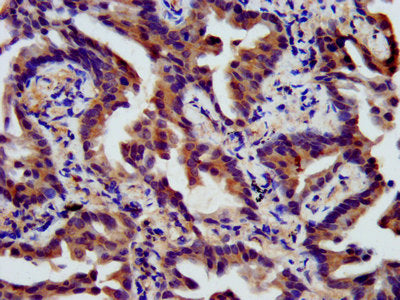 IHC image of SSH3 Antibody diluted at 1:400 and staining in paraffin-embedded human lung cancer performed on a Leica BondTM system.Rabbit anti-Human SSH3 Polyclonal Antibody