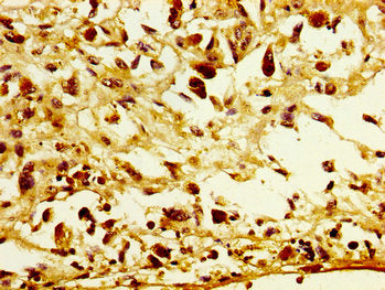 IHC image of POFUT2 Antibody diluted at 1:300 and staining in paraffin-embedded human melanoma performed on a Leica BondTM system. After dewaxing and hydration, antigen retrieval was mediated by high pressure in a citrate buffer (pH 6.0). Section was blocked with 10% normal goat serum 30min at RT. Then primary antibody (1% BSA) was incubated at 4°C overnight. The primary is detected by a biotinylated secondary antibody and visualized using an HRP conjugated SP system.