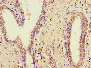 Immunohistochemistry of paraffin-embedded human prostate cancer using ZDHHC1 Antibody at dilution of 1:100Rabbit anti-Human ZDHHC1 Polyclonal Antibody