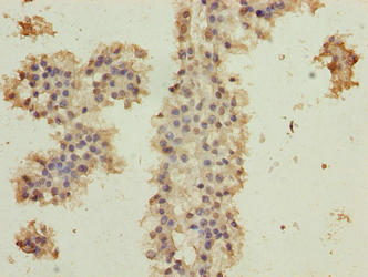 Immunohistochemistry of paraffin-embedded human breast cancer using C10orf82 Antibody at dilution of 1:100