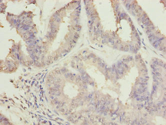 Immunohistochemistry of paraffin-embedded human endometrial cancer using C10orf82 Antibody at dilution of 1:100