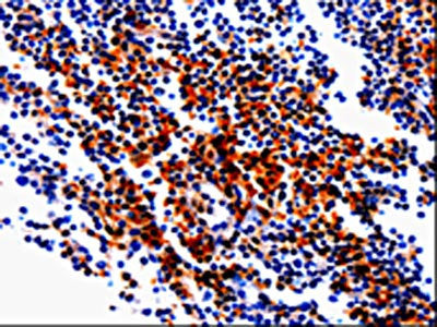 The image on the left is immunohistochemistry of paraffin-embedded Human tonsil tissue using GDI1 Antibody(GDI1 Antibody) at dilution 1/20, on the right is treated with fusion protein. (Original magnification: ×200)Rabbit anti-Human GDI1 Polyclonal Antibody