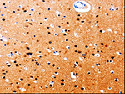 The image on the left is immunohistochemistry of paraffin-embedded Human brain tissue using the antibody Antibody) at dilution 1/20, on the right is treated with fusion protein. (Original magnification: ×200)Rabbit anti-Human GDI1 Polyclonal Antibody