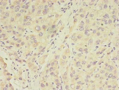 Immunohistochemistry of paraffin-embedded human liver cancer using RPGR Antibody at dilution of 1:100Rabbit anti-Human RPGR Polyclonal Antibody